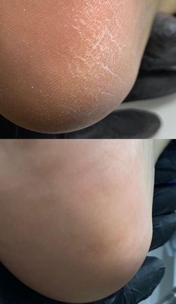 Спрей для розм&rsquo;якшення мозолів, кератолітик StraDerm, Callus Softener Spray, 500 мл L-106 фото
